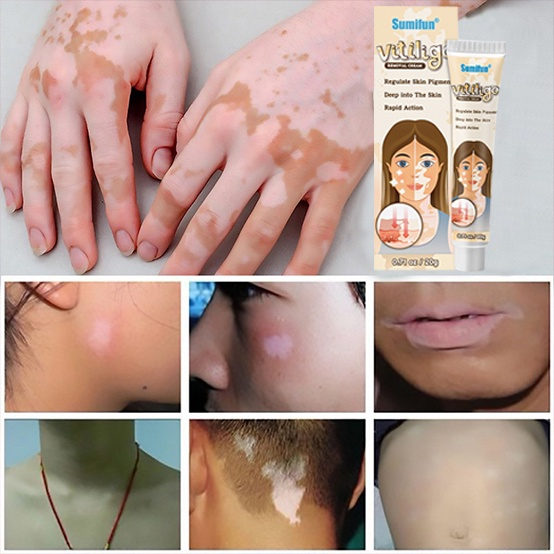 【HCM】Kem bôi bạch biến Mỡ Điều Bạch Biến Thảo dược bôi bạch biến 20g Loại bỏ đốm trắng nhanh chóng Làm Đều Màu Da Sửa