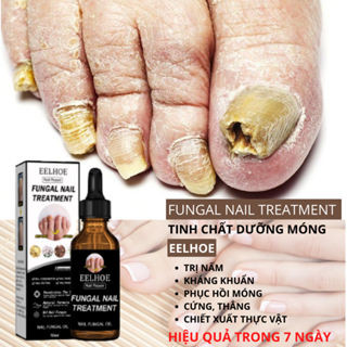 Nấm móng tay chân, dứt điểm nấm móng 30ML