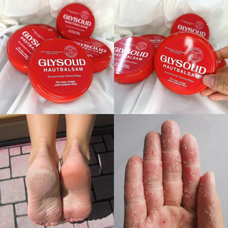 Kem dưỡng glysolid chăm sóc cho gót chân bị nứt nẻ, vẩy nến, á sừng