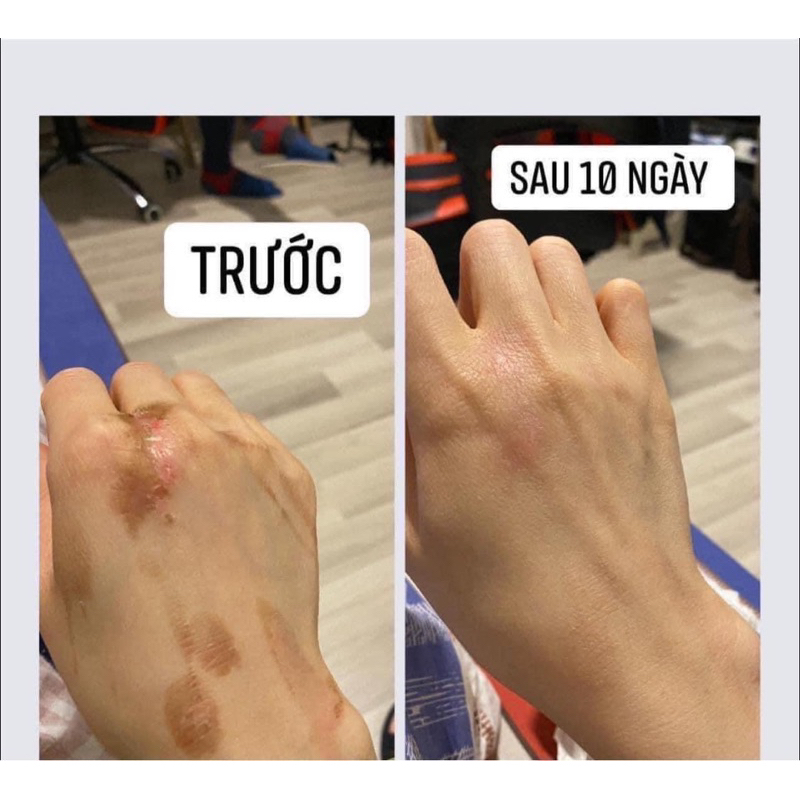 Mờ Sẹo Contratubex Đức