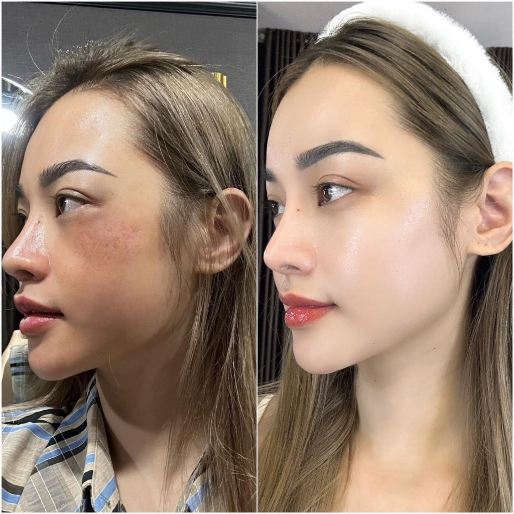 Serum nám moose+ 50ml giúp trắng da hạn dùng 2026