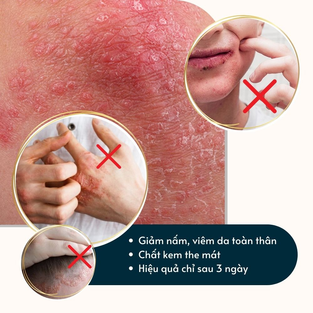 Kem bôi nấm da hắc lào mề đay vảy nến á sừng eczema Dego Pharma 30g