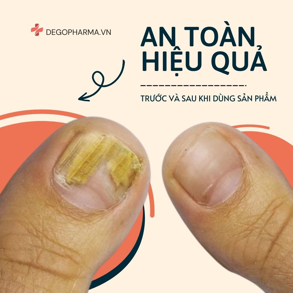 Tinh Chất Nấm Móng Dego Pharma - Hết Nấm Móng, Giảm Ngứa, Nuôi Dưỡng Tái Tạo Móng Mới