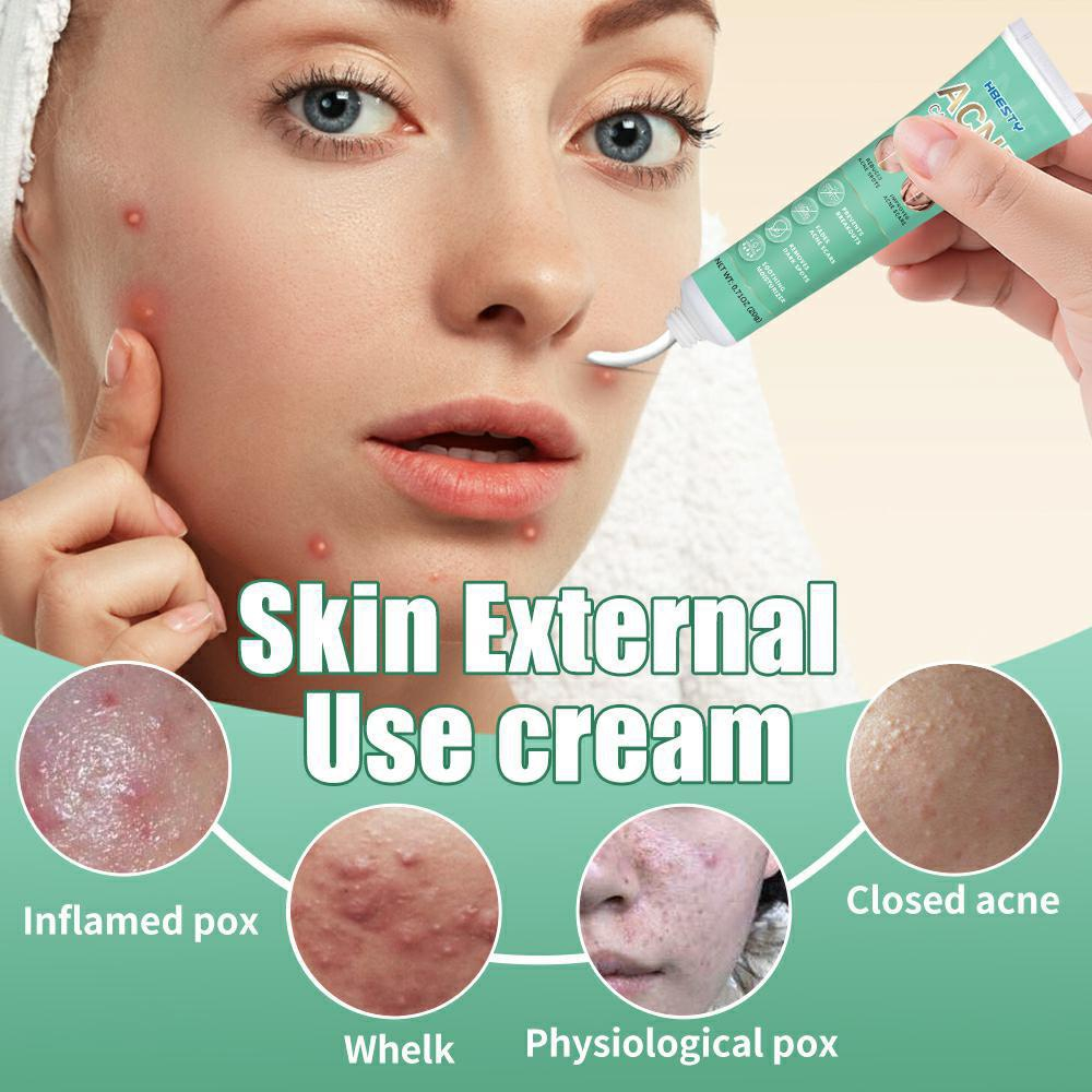 Acne Derm Kem giảm mụn, làm trắng da mờ thâm