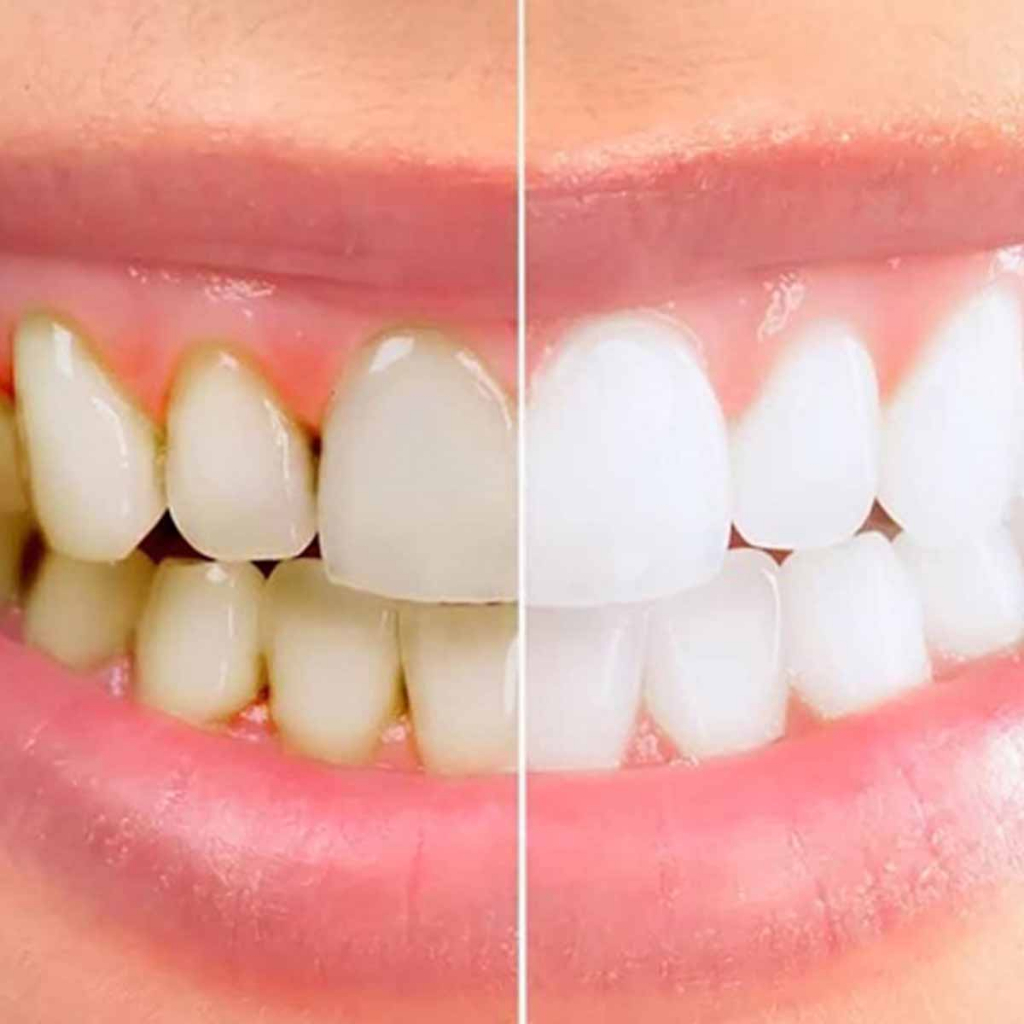 [E-voucher] Gói dịch vụ Tẩy trắng răng bằng phương pháp Laser Whitening 5P tại Nha khoa Bedental