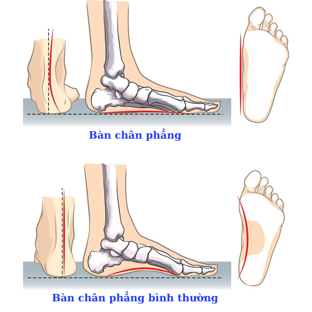 Lót Giày Chỉnh Hình Bàn Chân Bẹt - Hỗ Trợ Tạo Vòm Bàn Chân - Tùy Chọn Size Người Lớn Và Trẻ Em