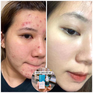 Serum trị mụn lumos acnes