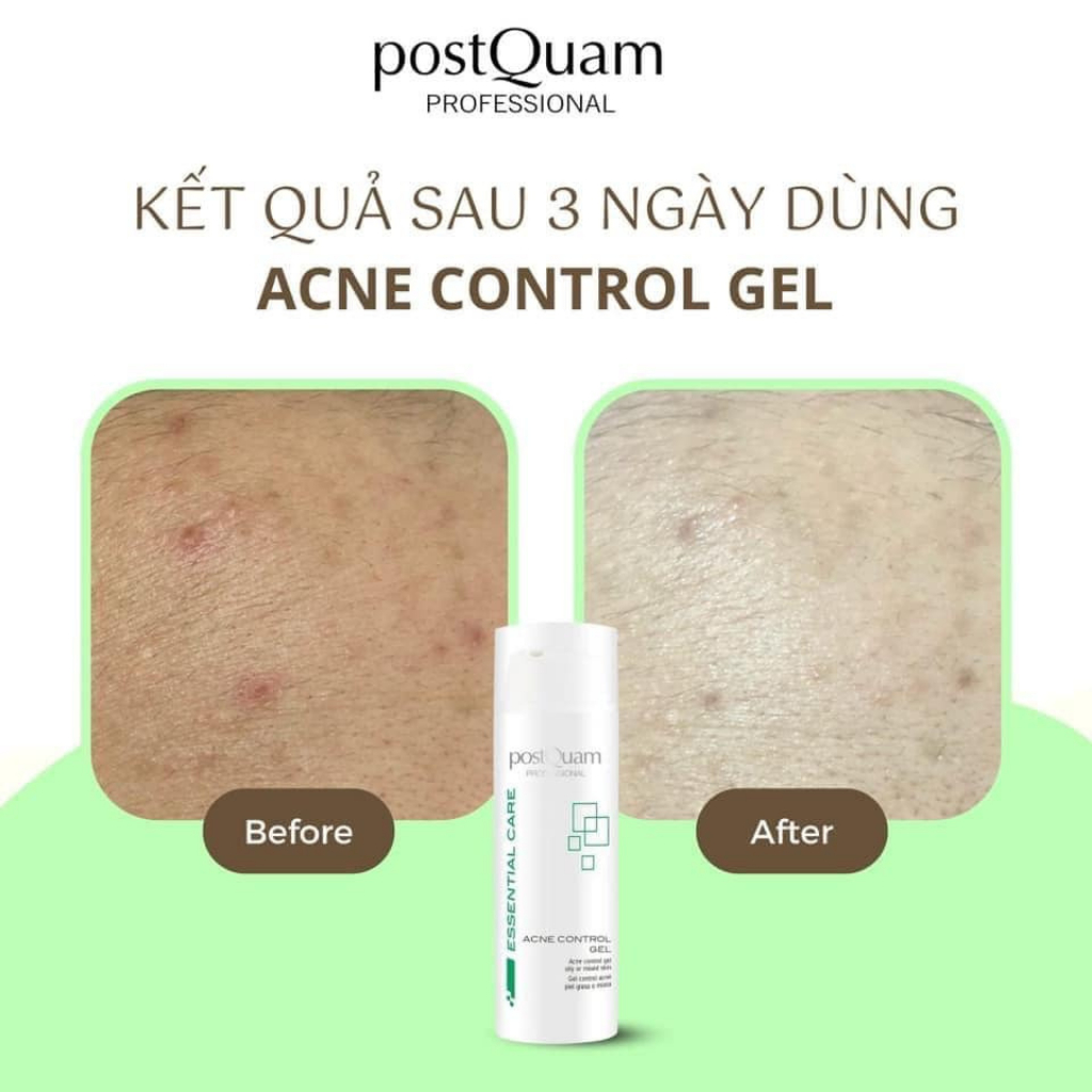 Gel dưỡng kiểm soát dầu mụn postQuam Acne Control Gel 50ml