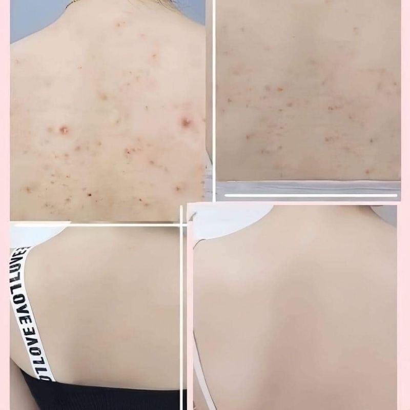 SỮA TẮM ADERMA __ MỤN LƯNG