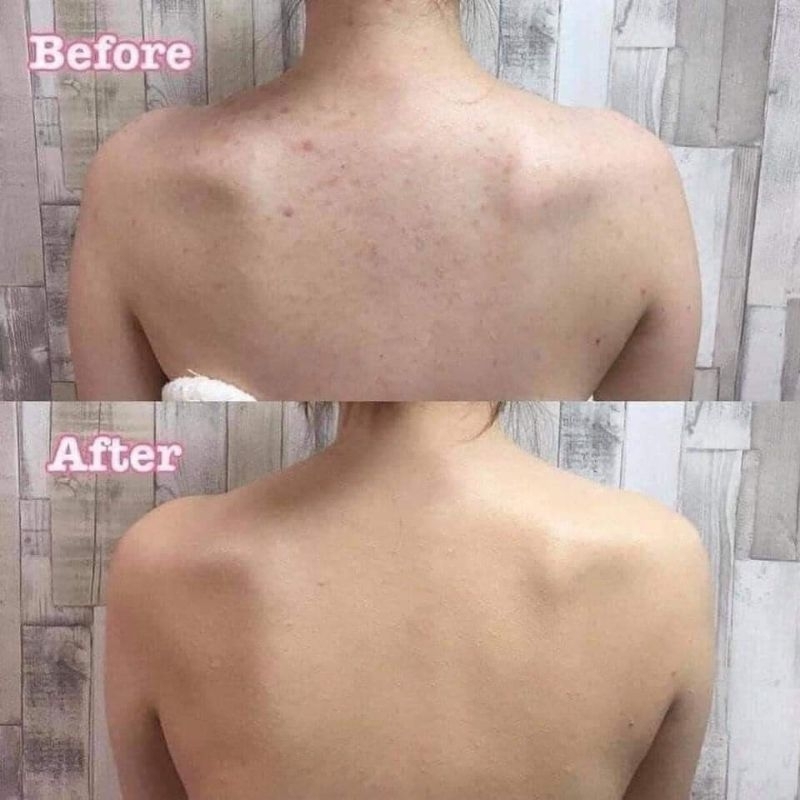 SỮA TẮM ADERMA __ MỤN LƯNG