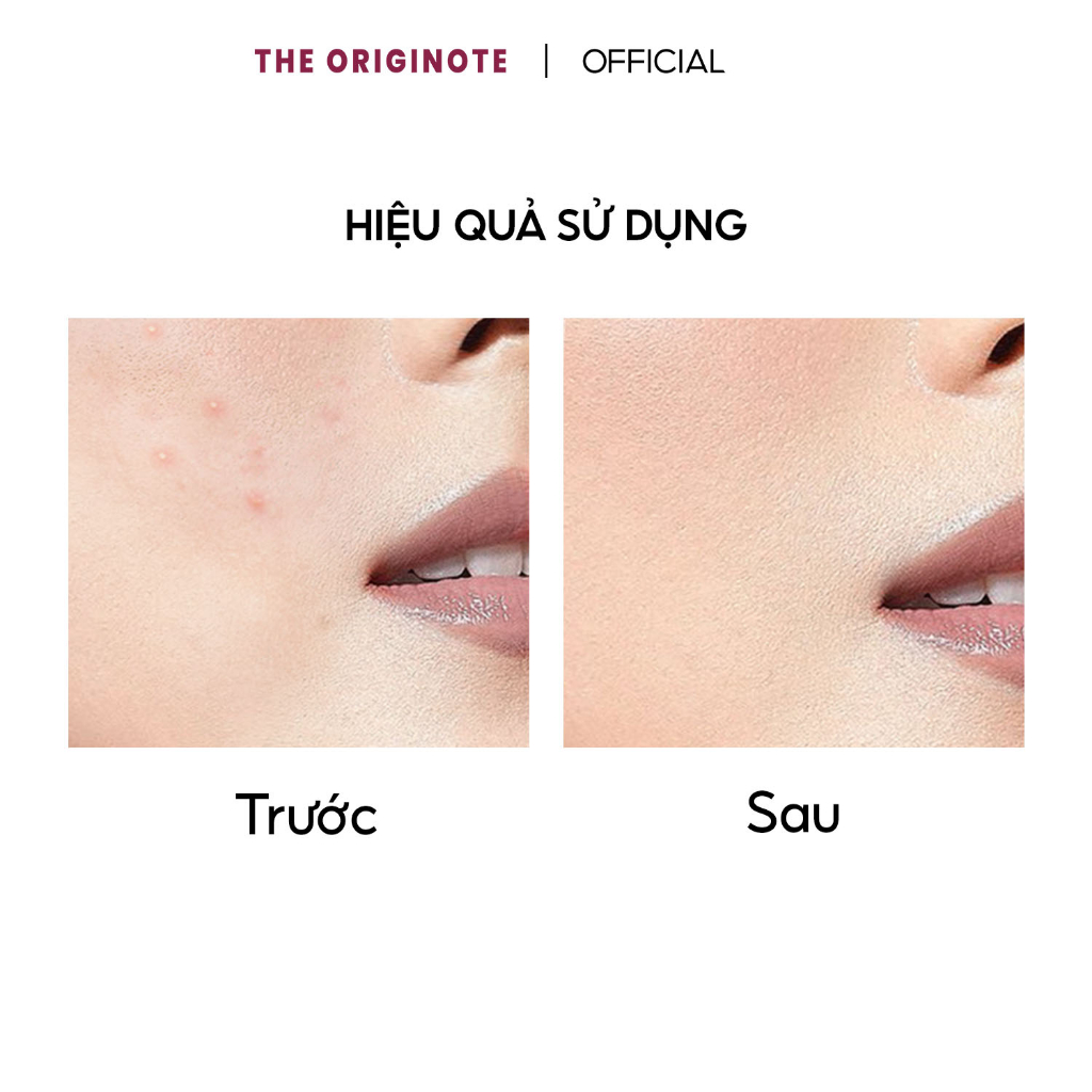 Kem chấm mụn The Originote với Salicylic Acid và Calamine Sulfur Acne Spot Cream 10gr