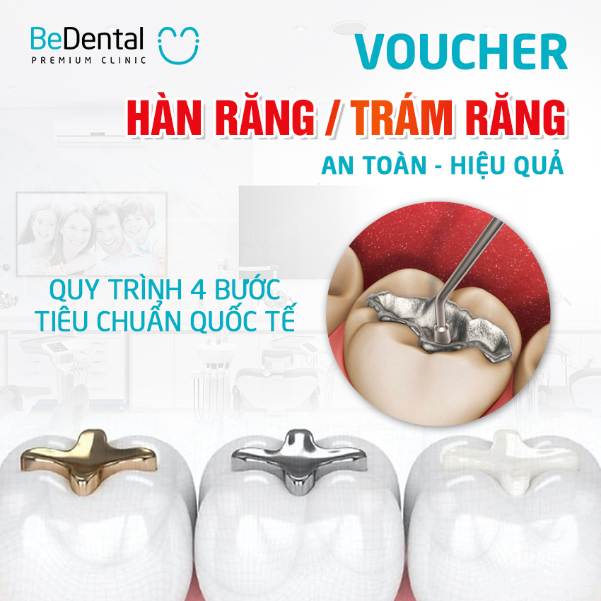 [E-voucher] Gói Hàn răng/Trám răng tại Nha khoa Bedental