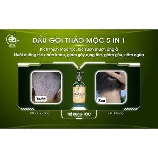 DẦU GỘI THẢO MỘC 5 IN 1 ELBON