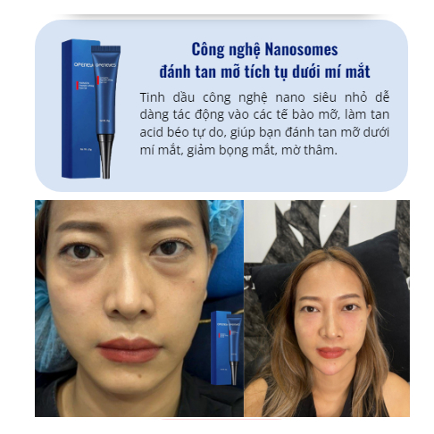 TẶNG MÁY MASSAGE Khi Mua Kem Tan Quầng Thâm Bọng Mắt Openeyes - Nhập Khẩu Chính Hãng Bán Chạy Tại Mỹ