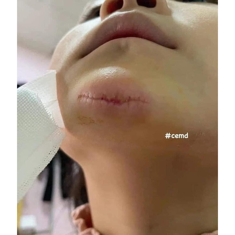 Kem bôi liền sẹo Contractubex Đức 30g và Balan 20g làm mờ  sẹo lồi, sẹo lõm, vết thâm bỏng bô xe máy