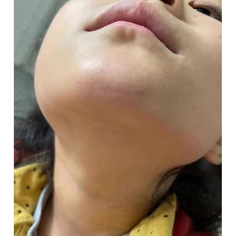 Kem bôi liền sẹo Contractubex Đức 30g và Balan 20g làm mờ  sẹo lồi, sẹo lõm, vết thâm bỏng bô xe máy