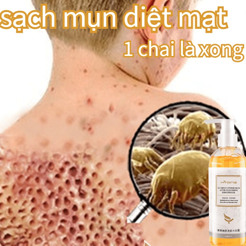 Sữa tắm viêm nang lông sữa tắm sạch khuẩn xà phòng mụn lưng làm trắng da loại bỏ mụn lưng nhanh