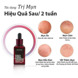 Red Peel Tingle Serum Premium 20ML Tinh Chất Tái Tạo Peel Da Sinh Học  So Natural Chính Hãng Hàn Quốc [Mẫu Mới 2020]