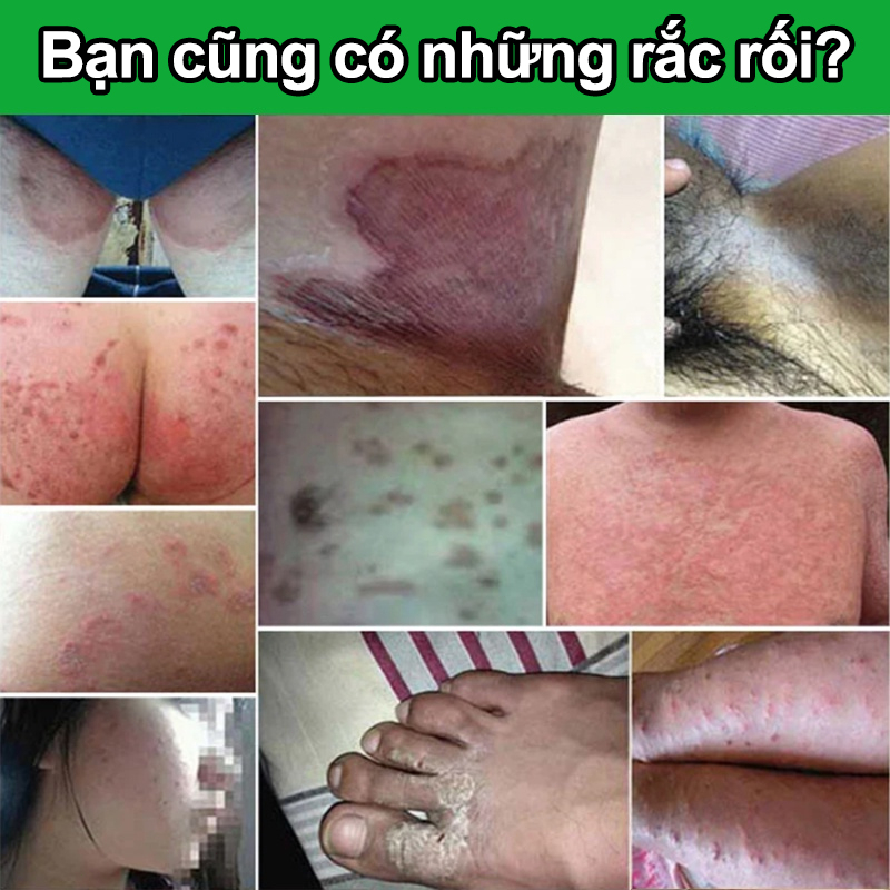 Chăm sóc vùng kín kem Kem giảm ngứa Dùng bên ngoài loại bỏ vùng kín Nấm Ngứa hôi hám kháng khuẩn Làm sạch sâu 30g