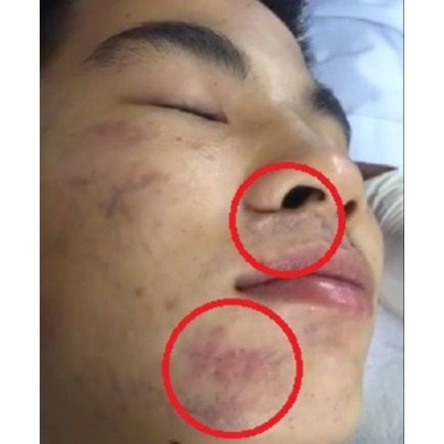 Kem Làm Mờ Sẹo: Sẹo Rỗ, Sẹo Thâm, Sẹo Lõm, Sẹo Thuỷ Đậu, Tai Nạn - Scar Esthetique 10ml-KTSM