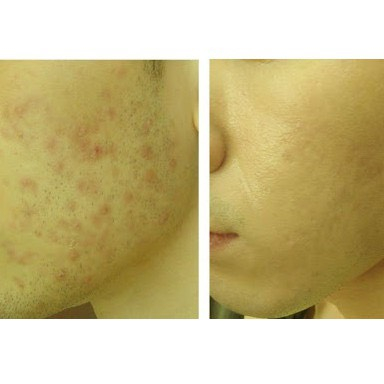 Kem Làm Mờ Sẹo: Sẹo Rỗ, Sẹo Thâm, Sẹo Lõm, Sẹo Thuỷ Đậu, Tai Nạn - Scar Esthetique 10ml-KTSM