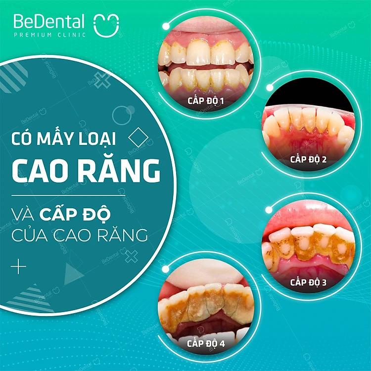 Evoucher - Lấy Cao Răng  Và Đánh Bóng Công Nghệ Siêu Âm Mới - Nha khoa BeDental 