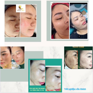 Navo Peel 01