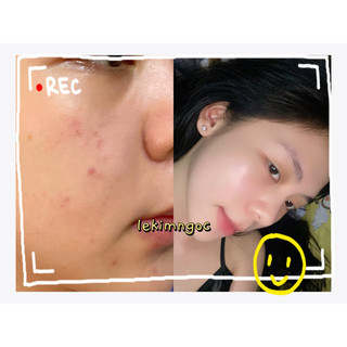 Combo ( 2-5 hủ face mụn 15gr )