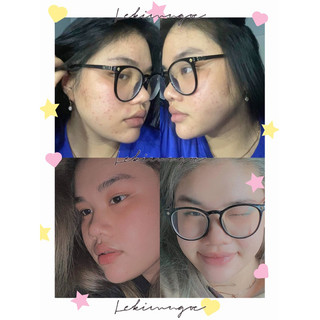 Combo ( 2-5 hủ face mụn 15gr )