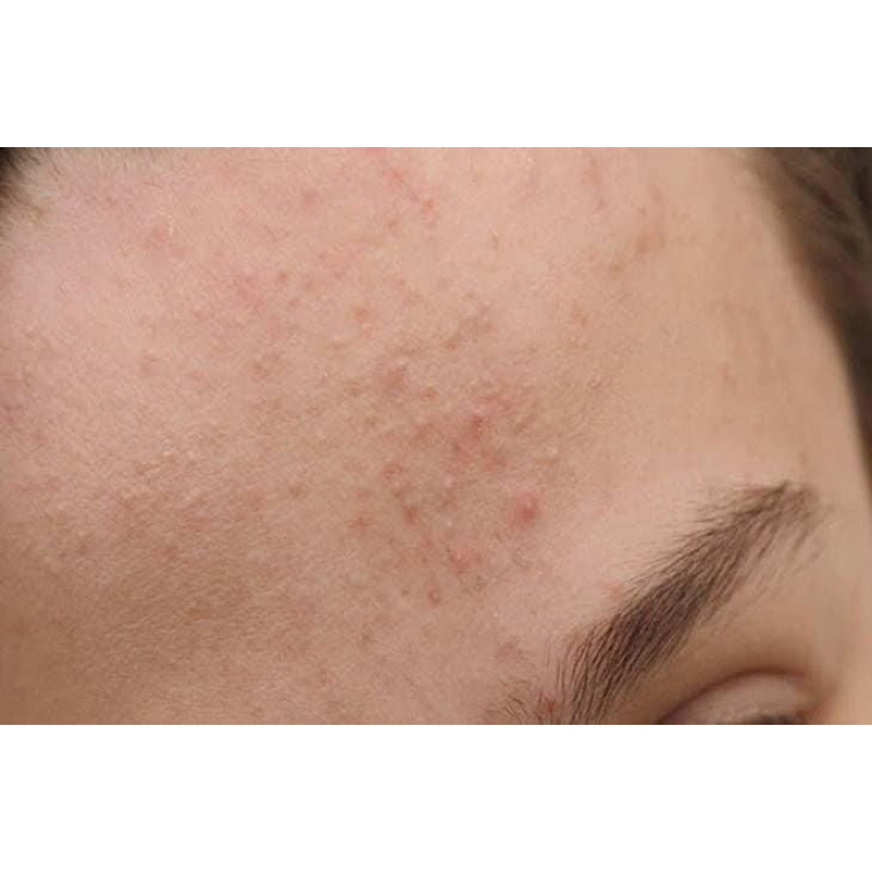 Gel Giảm Mụn Giảm Thâm Actidem Derma Gel 18g