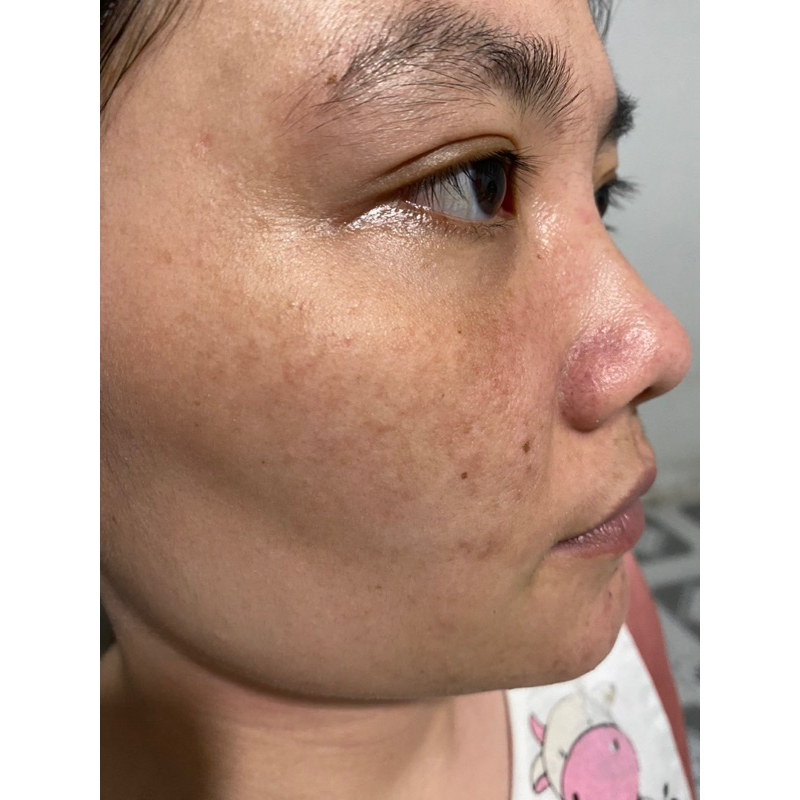 BỘ NÁM TÀN NHANG , MỤN LCL THÂM MẮT ,CHÂN SÂU DA NHIỀU NẾP NHĂN LÃO HOÁ DA BỊ  COD