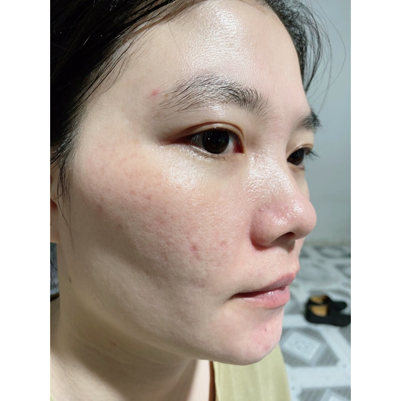 BỘ NÁM TÀN NHANG , MỤN LCL THÂM MẮT ,CHÂN SÂU DA NHIỀU NẾP NHĂN LÃO HOÁ DA BỊ  COD