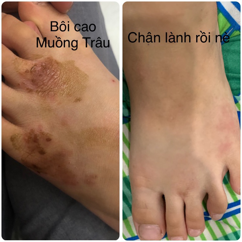 Cao lá Muồng Trâu 50ml