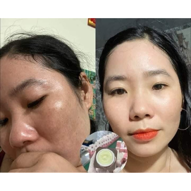 Combo Peel Da & Phục Hồi Da Nicos Thanh Nhi Chính Hãng