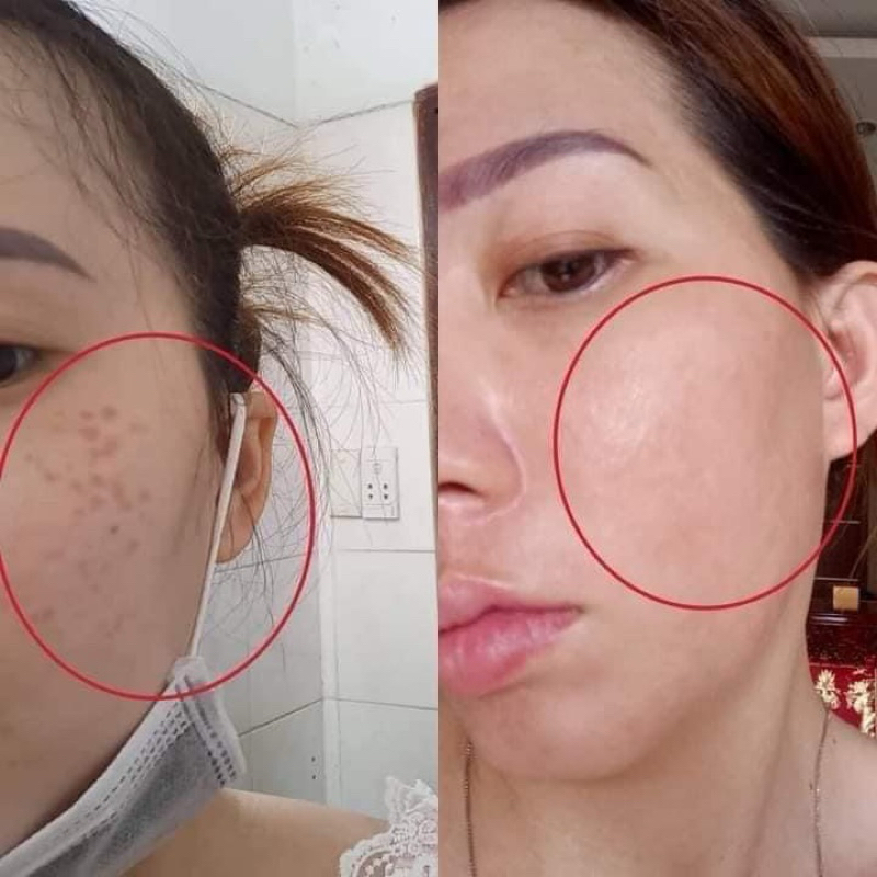 Combo Peel Da & Phục Hồi Da Nicos Thanh Nhi Chính Hãng