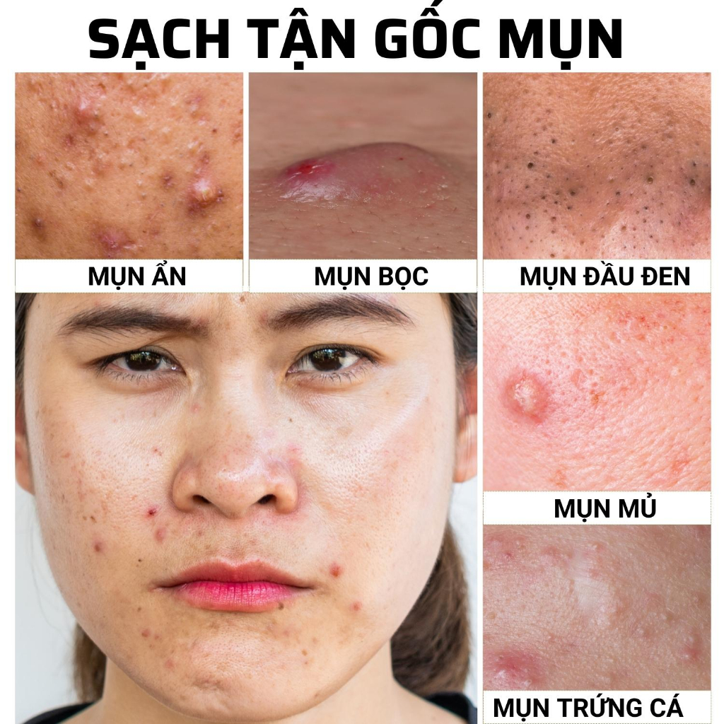 Kem giảm Mụn ẩn ,Mụn đầu đen cho da dầu Doctor Care Acnes Elimination Cream 30G
