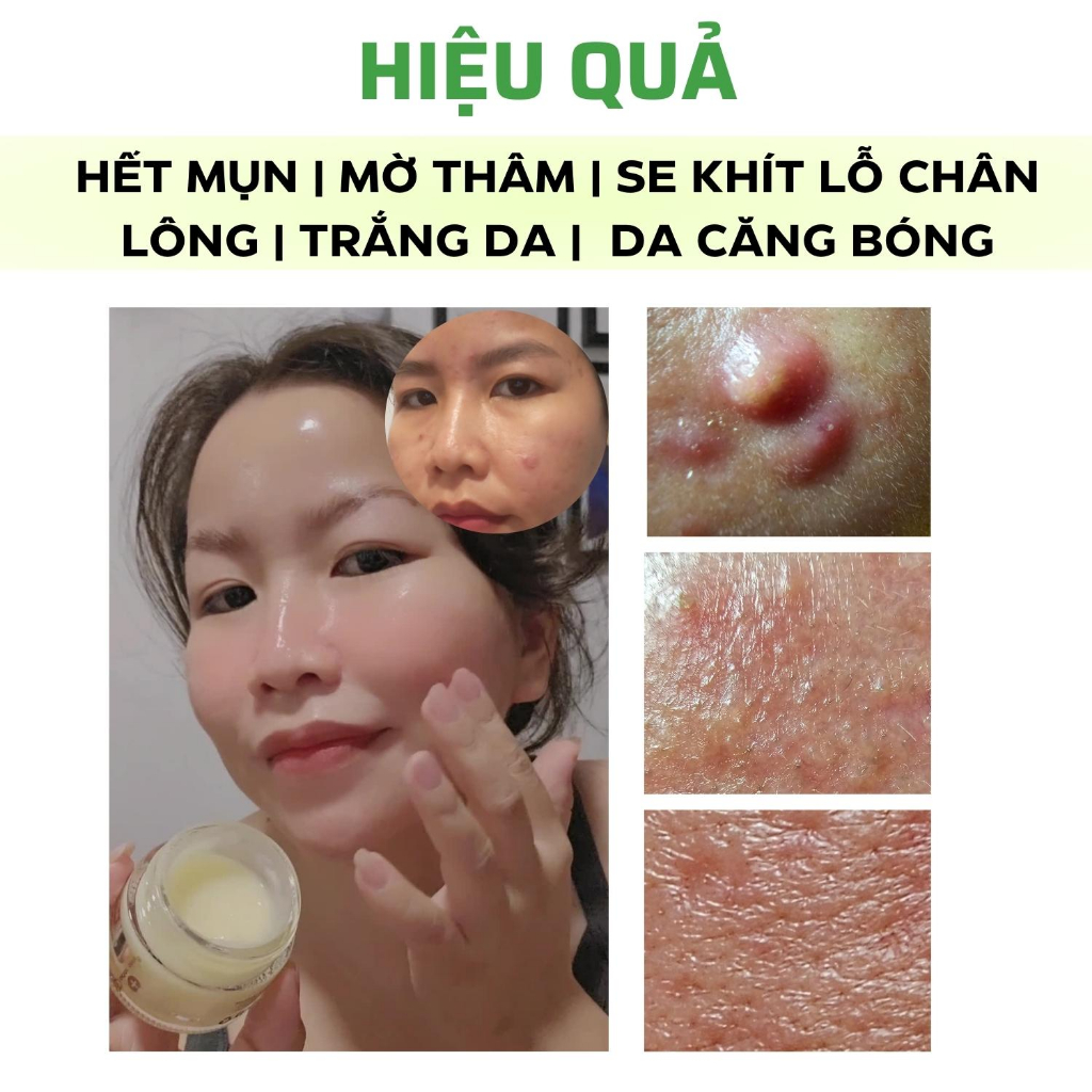 Kem giảm Mụn ẩn ,Mụn đầu đen cho da dầu Doctor Care Acnes Elimination Cream 30G