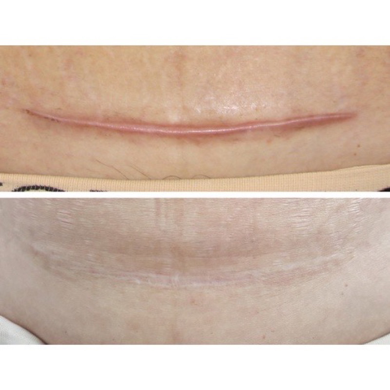 Scar FX Miếng Dán Làm Xẹp Sẹo Lồi / Phì Đại, Ép Sẹp REJUVASKIN Scar FX