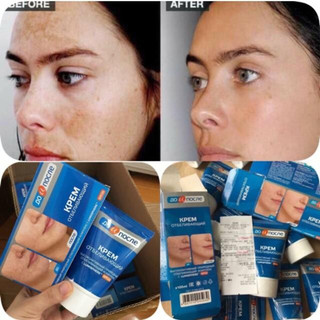 Kem xóa nám trắng da Kpem Nga 100ml (Kem nám xanh)