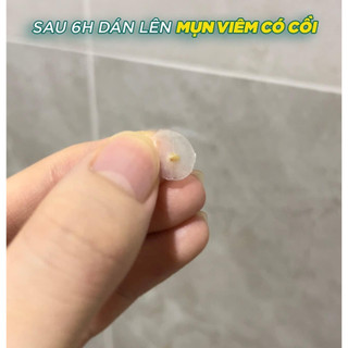 [ LẺ 1 MIẾNG ] Miếng dán mụn CAREZONE Doctor Solution A-Cure Spot Patch