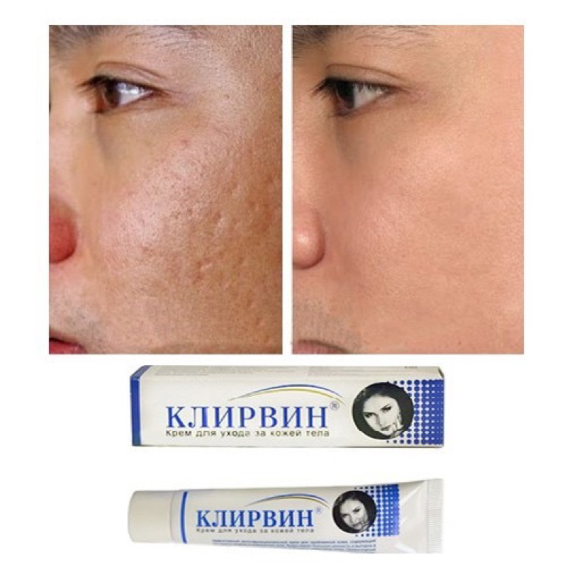 Kem Mờ Sẹo, Mờ Thâm, Rạn Da Klirvin 25g [Chính Hãng Nga]