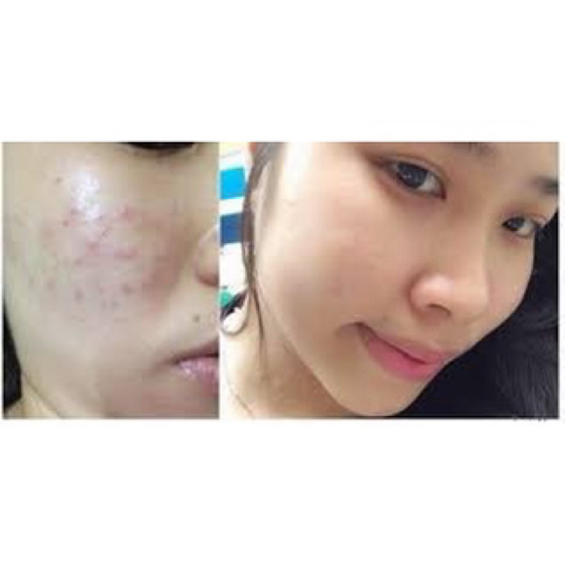 Kem Mờ Sẹo, Mờ Thâm, Rạn Da Klirvin 25g [Chính Hãng Nga]