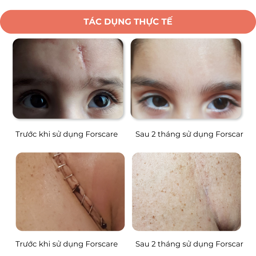 Gel làm giảm sẹo Forscar Scar Recovery Gel thường và UV nhập khẩu Châu Âu