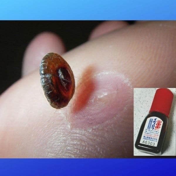 Tinh chất bôi mụn cóc Ibokorori Nhật Bản 10ML, giúp bạn thoát khỏi sự phiền toái mà mụn cóc mang lại