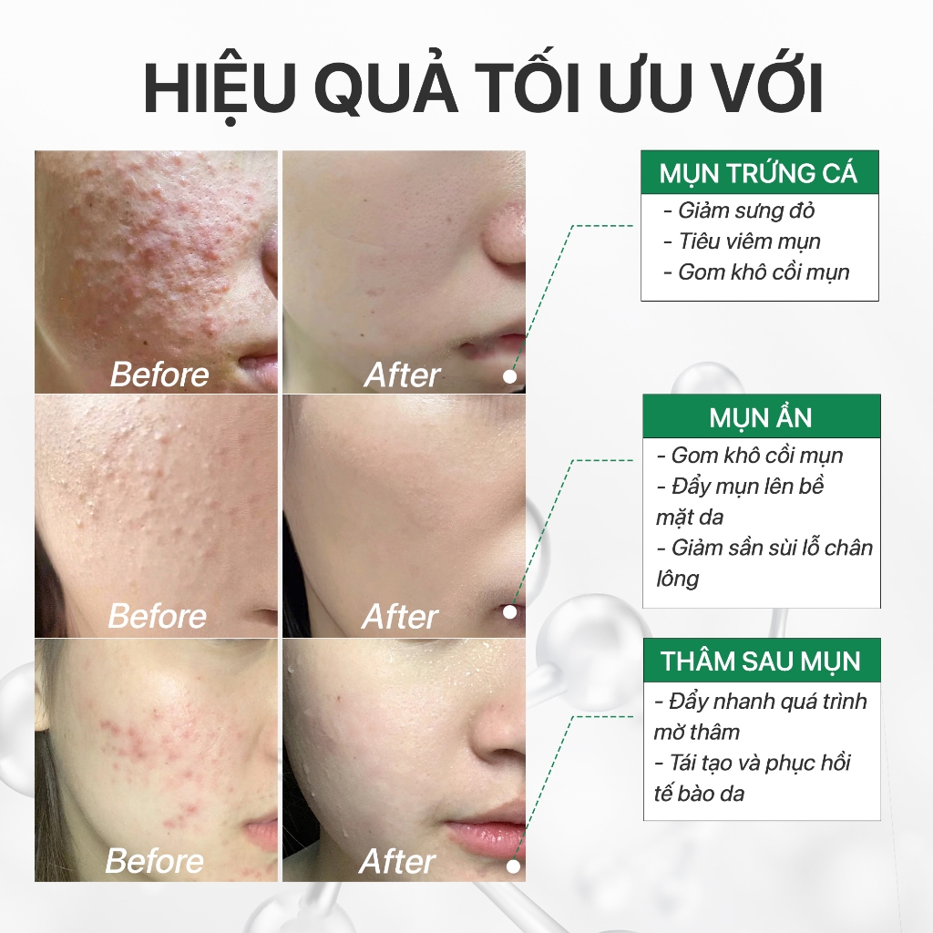 Serum giảm mụn, mờ thâm BHA 1%+AHA 2%+tràm trà, giảm sợi bã nhờn hiệu quả GUO 30ml