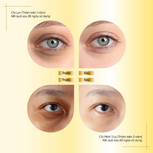 Kem giảm thâm mắt Rena Abera giúp giảm thâm mắt, bọng mắt, nếp nhăn vùng mắt, làm cho vùng da mắt sáng mịn