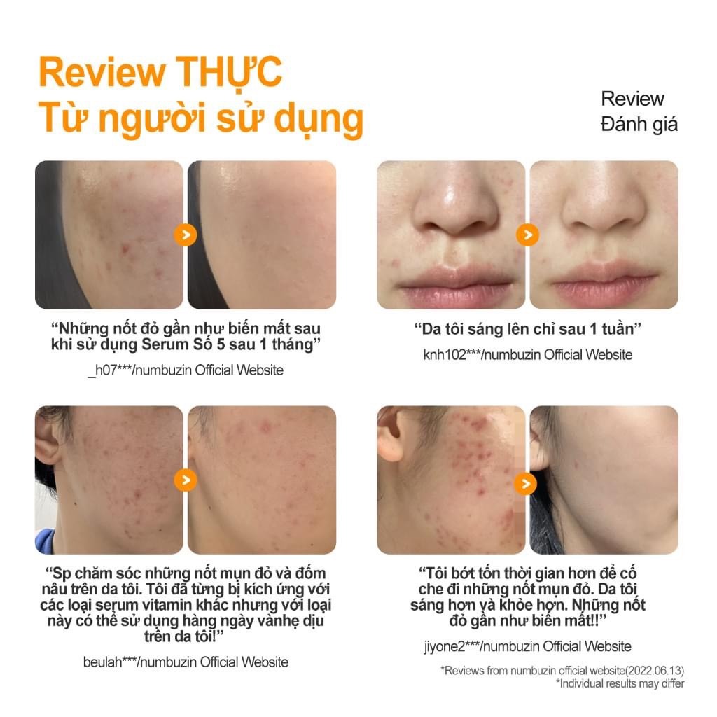 Tinh Chất Dưỡng Da Mụn Numbuz:n No.5 Goodbye Blemish Serum 50ml