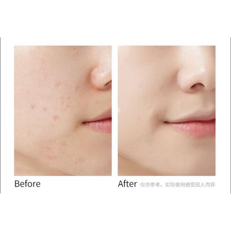 Cushion Renoderm phấn nước siêu đẹp và tự nhiên dành cho da Treatment