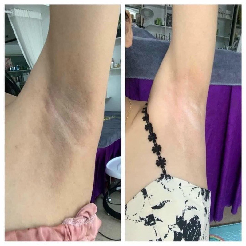 01 Hủ Kem dưỡng Nách Q-nic Care Thái Lan