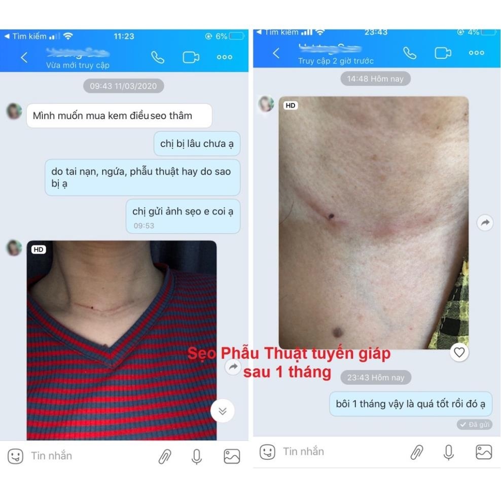 Miếng Dán Xẹp Sẹo Lồi / Phì Đại REJUVASKIN Scar Fx 1x20cm - 2x20cm - 3x20cm - 5x10cm - 10x10cm Chính Hãng